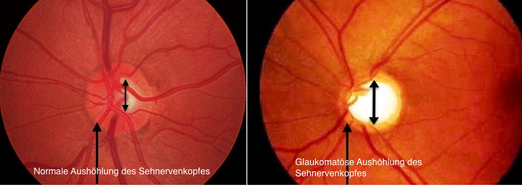 augenarzt reinickendorf/glaukomdiagnostik